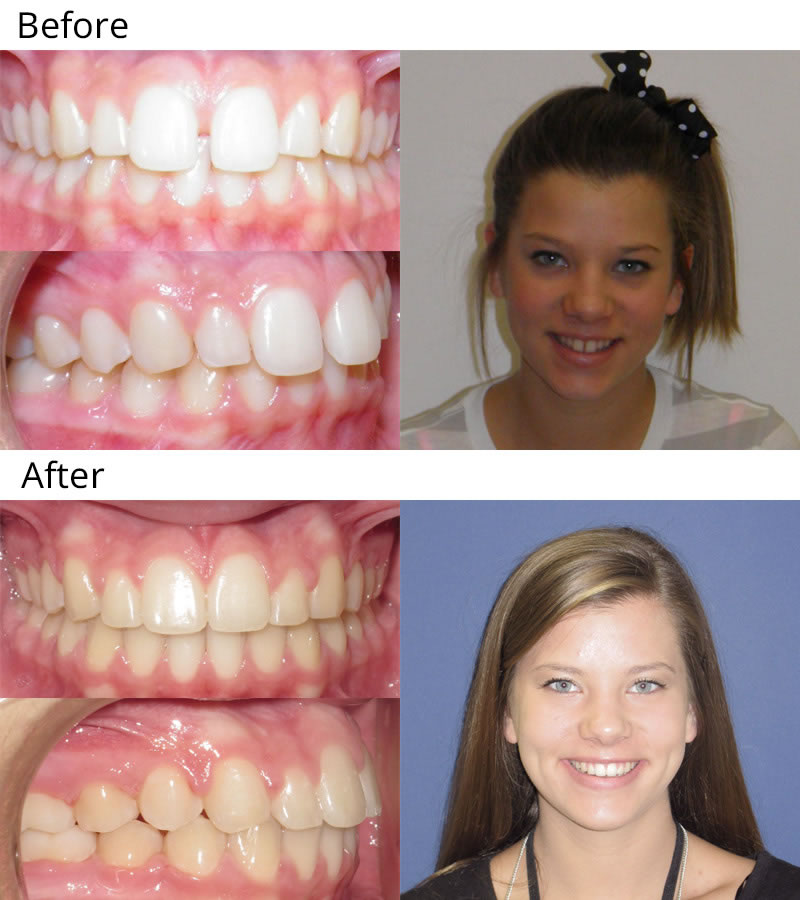 Patient 8: Madison (14 years old) - Madison was concerned with the gap between her two front teeth and felt that her teeth were too long. She had braces to close the space and Dr. Cali shaped her teeth to give her a beautiful, harmonious smile.
