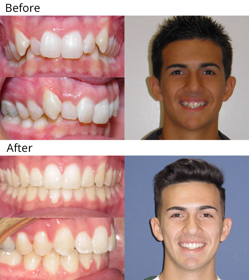 Patient 1: Alex (13 years old) - Patient had crowding of the upper and lower teeth with an excessive overbite and uneven smile. He had upper and lower braces and wore rubber bands to correct his bite. Dr. Cali did some laser treatment on the upper front teeth to lengthen them at the end of treatment. Now he has a very nice even smile that he can show off.