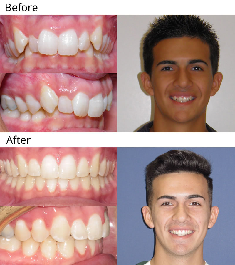 overbite before and after