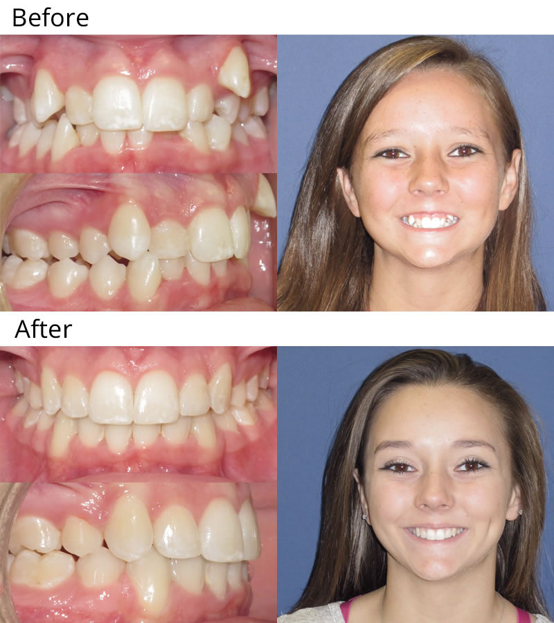 Patient 10: Gabi (12 years old) - Gabi’s teeth were severely crowded and she did not like the appearance of her upper teeth. Gabi had upper and lower braces to align her teeth. After orthodontics, the short upper teeth were lengthened with laser treatment to give her a smile she can be proud to show off.