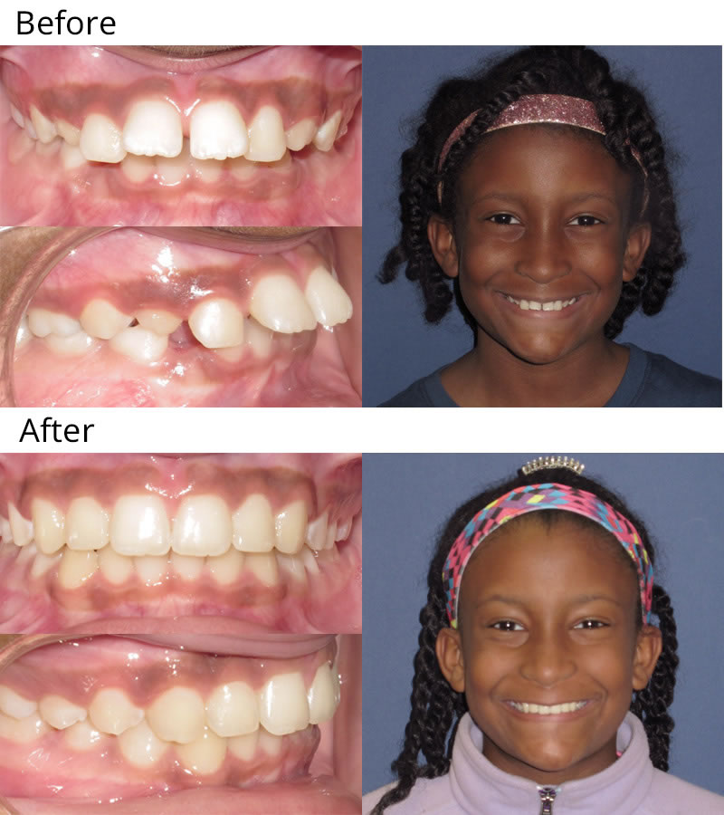 Patient 2: Zakayia (9 years old) - Zakayia was self-conscious of her teeth because of the way they stuck out. She had a Phase I treatment consisting of an upper expansion appliance to widen her smile and upper braces to align the teeth and give her a great smile! She will complete her treatment when all of the permanent teeth have erupted.