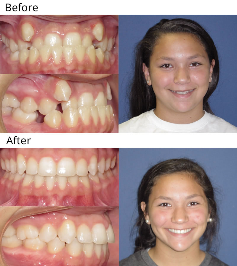 Patient 3: Gracie (12 years old) - Gracie was did not like the appearance of her upper canines and she had an anterior underbite (upper teeth inside of the lower) and some of the teeth were impacted (unable to erupt). She had upper and lower braces and removal of four teeth to help resolve the crowding and improve the bite. Such an amazing transformation!