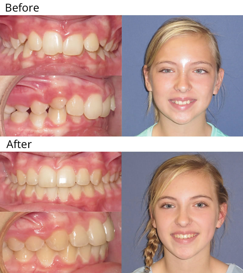 Patient 4: Darian (11 years old) - Darian had a deep overbite and misalignment and chipping of the upper and lower teeth. She had upper and lower braces to straighten her teeth and give her a healthy bite. Her teeth were shaped during treatment to eliminate the chipped edges. What a beautiful girl with a smile to match!