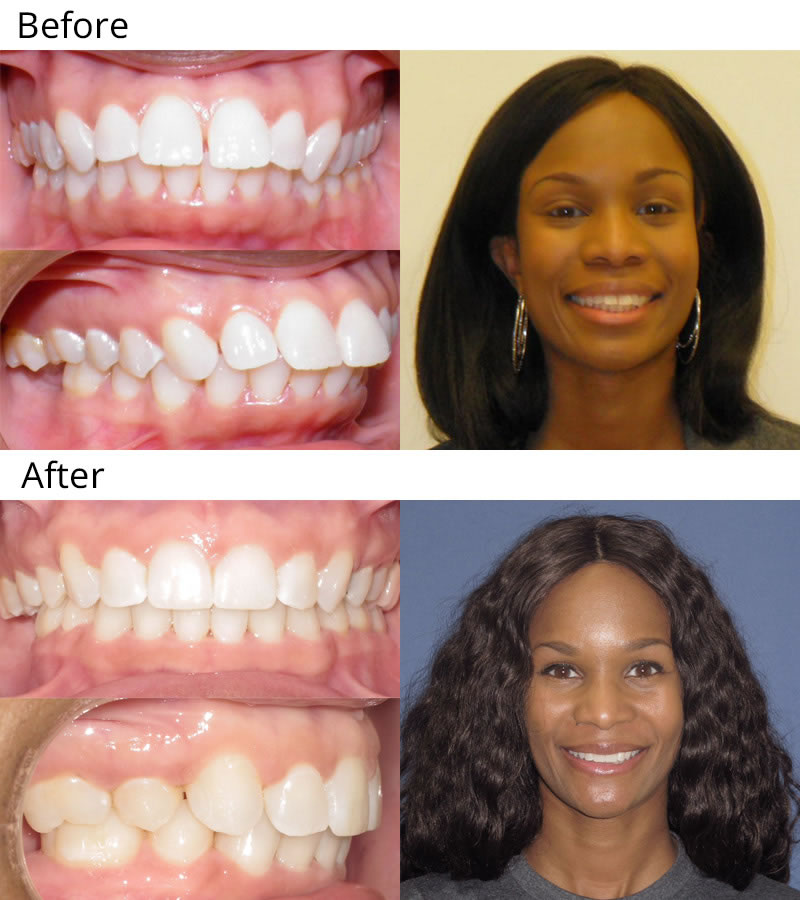 Patient 5: Akeiah (31 years old) - Akeiah was unhappy with the fullness of her teeth. She felt like they stuck out too much and wanted them moved back. She had upper and lower braces and removal of four teeth to bring her teeth back and improve her profile and smile. She is very happy to have the smile she always wanted!