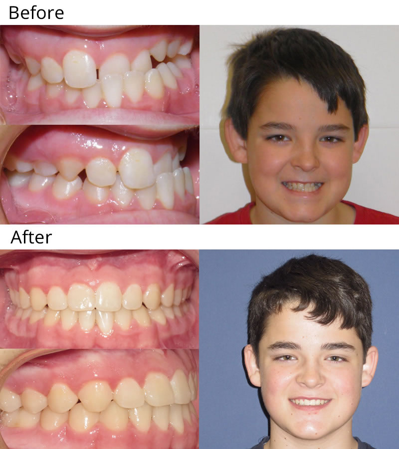Patient 6: Austin (12 years old) - Austin had a partial crossbite of the anterior teeth and asymmetry of the upper and lower arches. He had upper and lower braces and used rubber bands to correct his bite and give him an awesome smile.