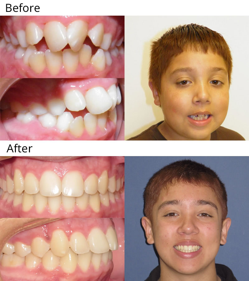 Patient 7: Angelo (10 years old) - Angelo started with an extremely narrow upper arch and upper and lower crowding. He had Phase I treatment with an upper expansion appliance and upper braces and later Phase II treatment with upper and lower braces to complete his treatment.