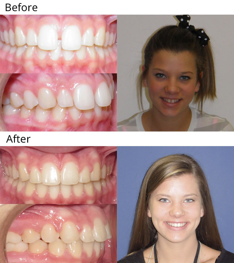 buck teeth before and after braces