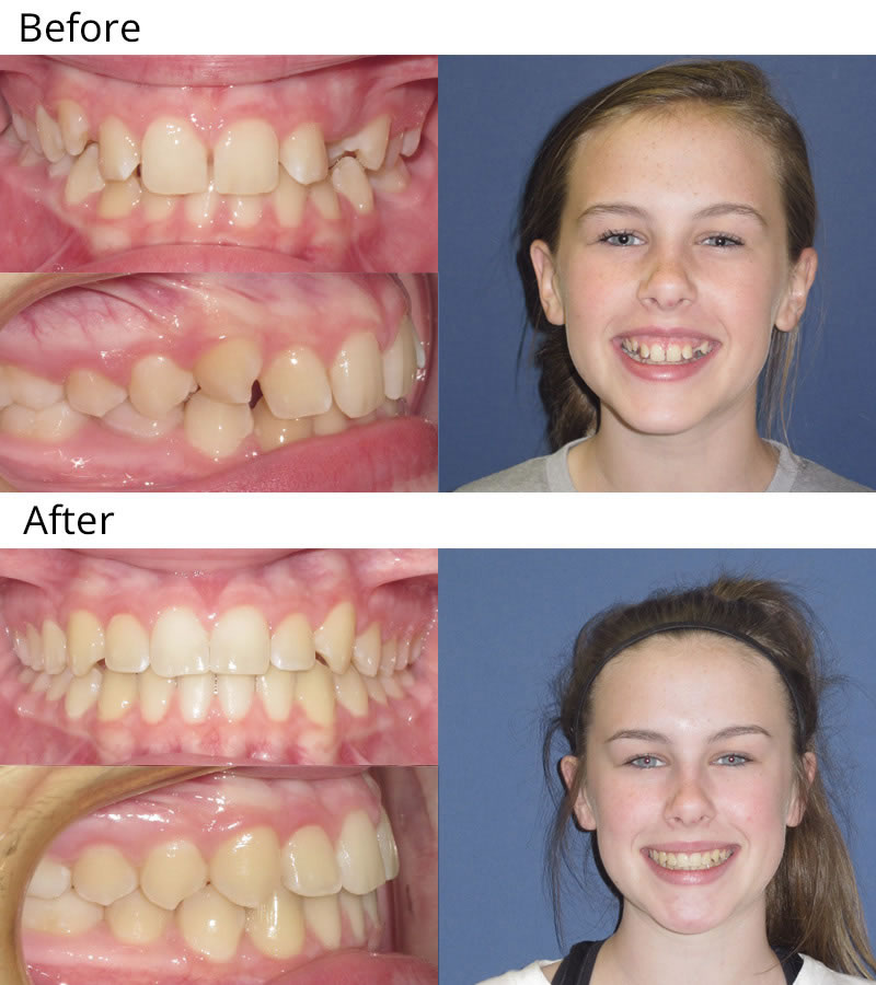 Patient 9: Rinna (12 years old) - Rinna was concerned with the spacing and alignment of her teeth. She had upper and lower braces to straighten her teeth and improve the “gummy” smile. Now she has an awesome smile to match her super sunny personality!