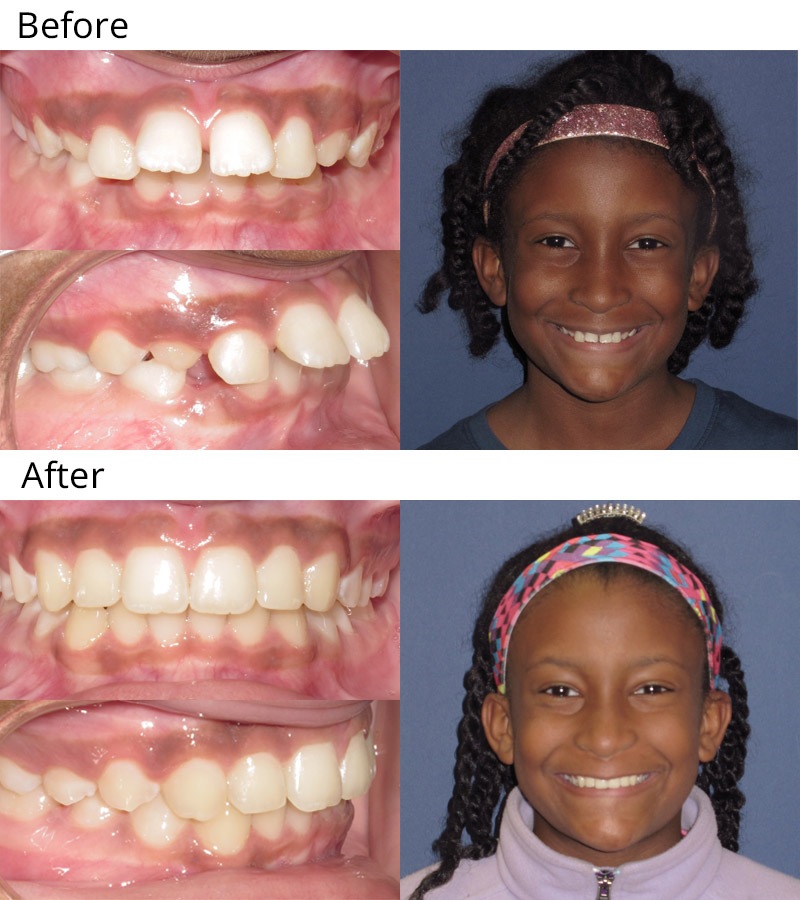how to straighten teeth with rubber bands